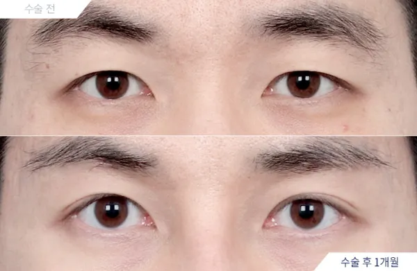 Before/After