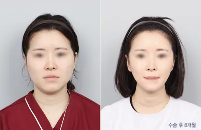 Before & After