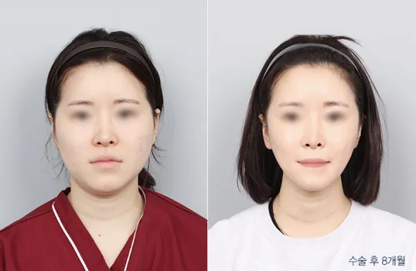 Before/After