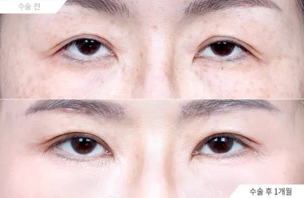 Before/After