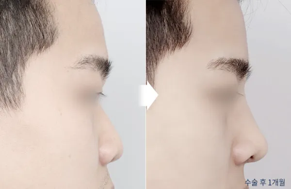 Before/After