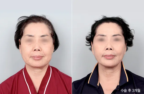 Before/After