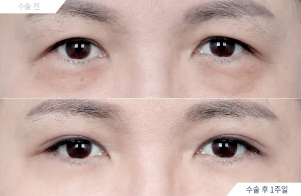 Before/After