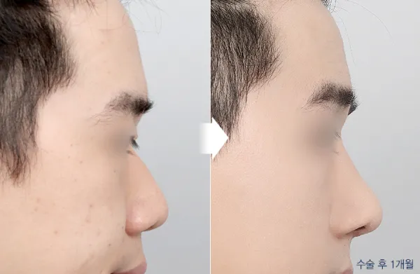 Before/After