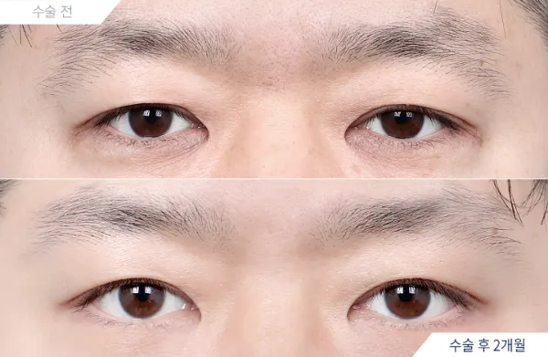 Before/After