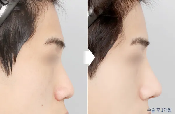 Before/After