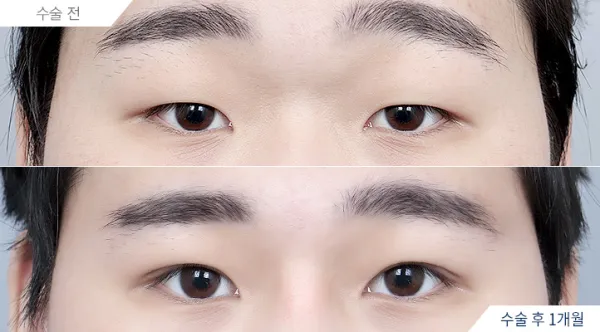Before/After