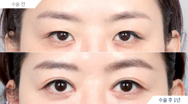Before/After