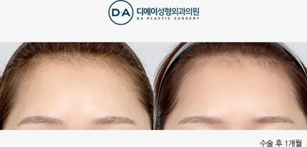 Before/After
