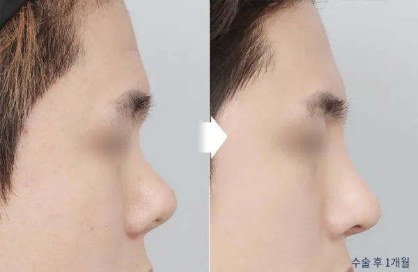 Before/After