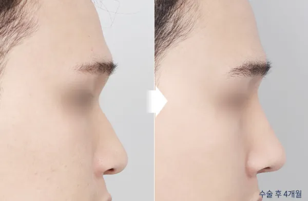 Before/After