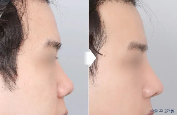 Before/After