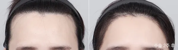 Before/After