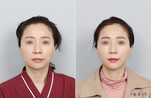 Before/After