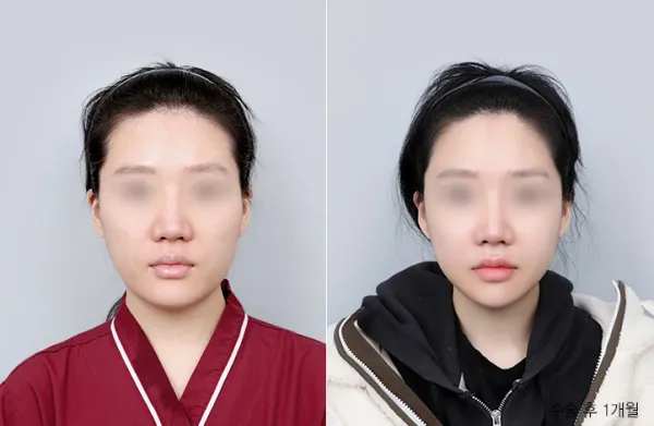 Before/After