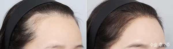 Before/After