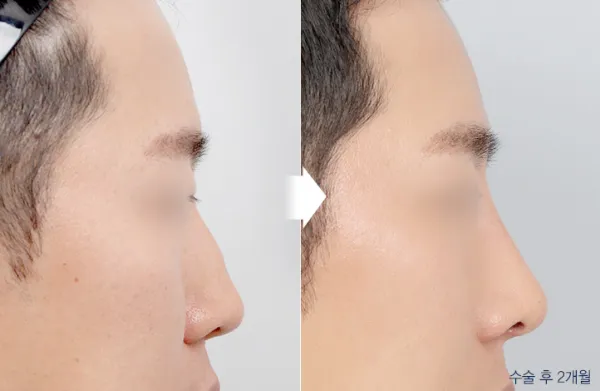 Before/After