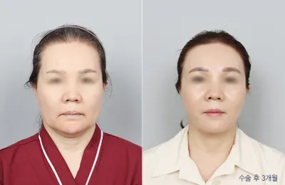 Before & After