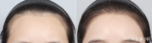 Before/After
