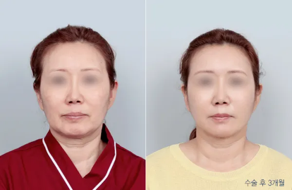 Before/After