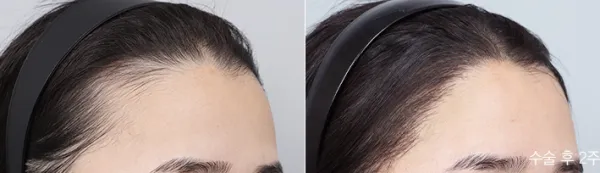 Before/After