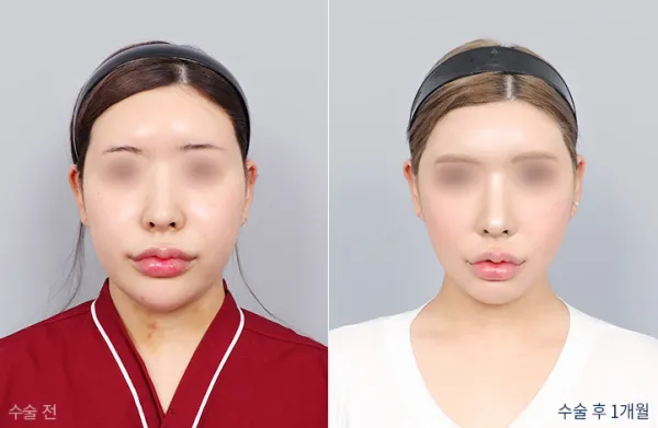 Before/After
