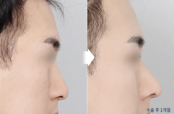 Before/After