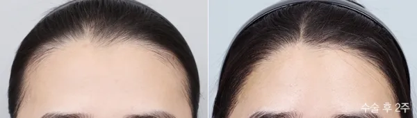 Before/After