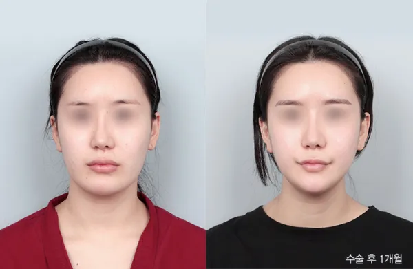Before/After