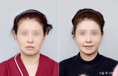 Before & After