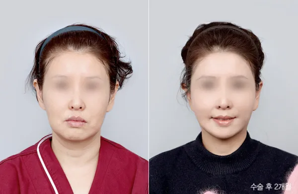 Before/After