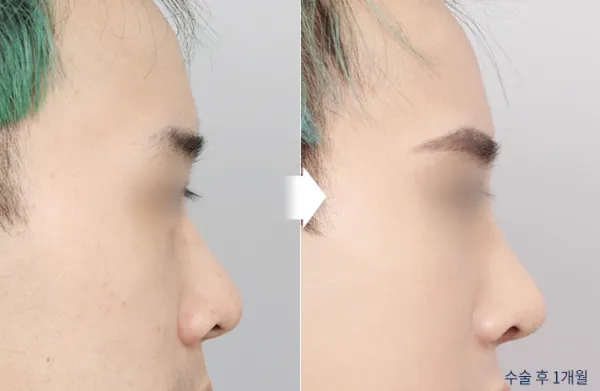 Before/After