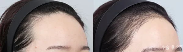 Before/After