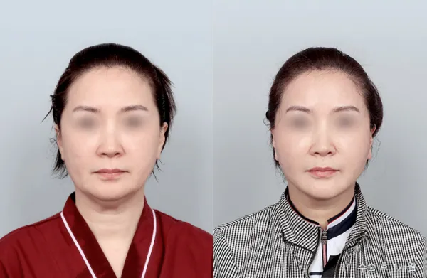 Before/After