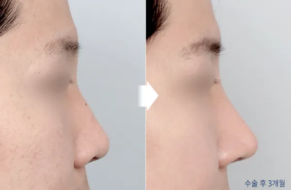 Before/After