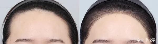 Before/After