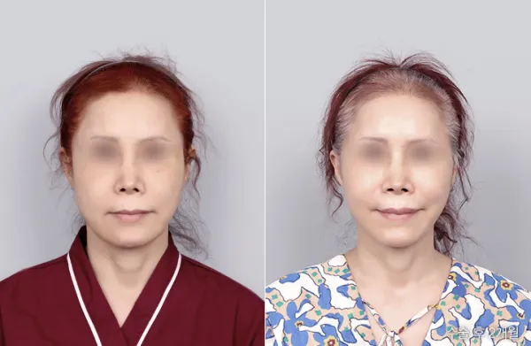 Before/After