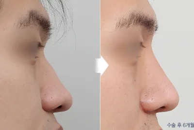 Before & After