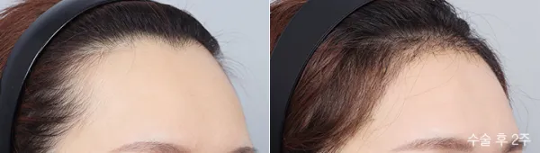 Before/After