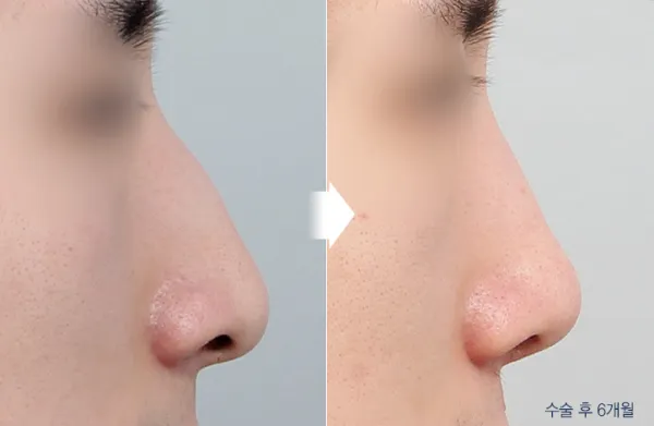 Before/After