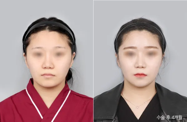 Before/After