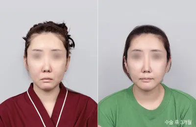 Before & After