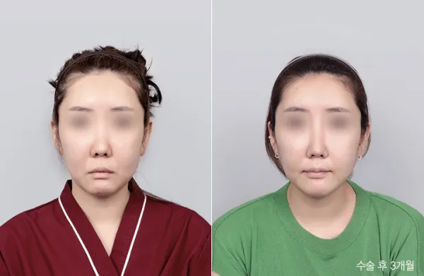 Before/After