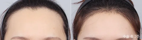 Before/After