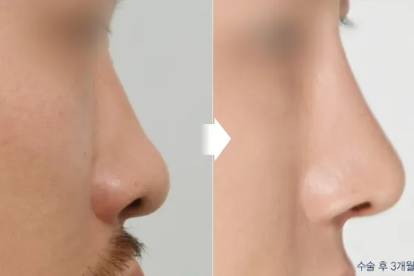Before/After