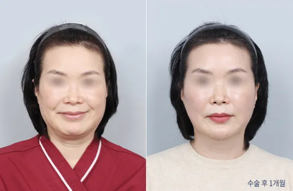 Before/After