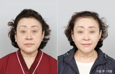 Before & After