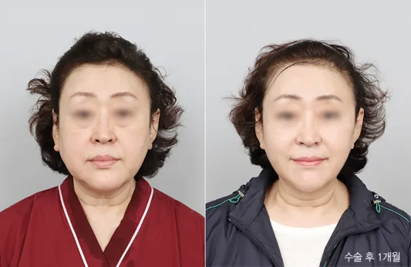 Before/After