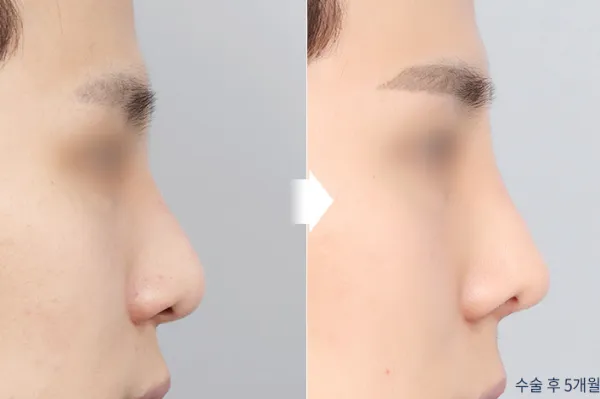 Before/After