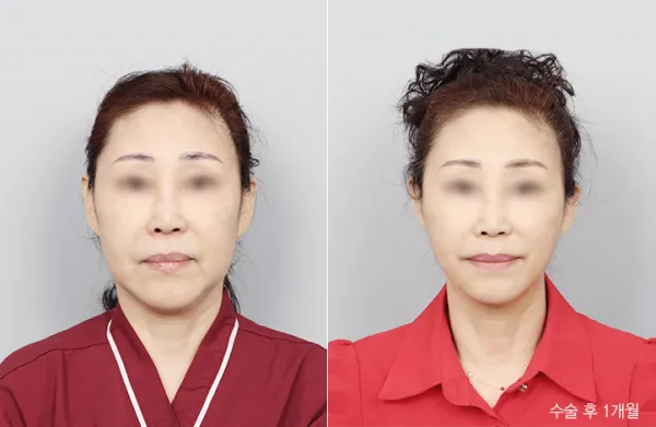 Before/After